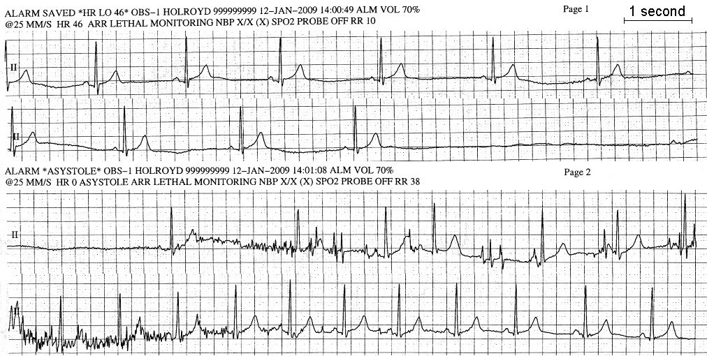 regular irregular heartbeat